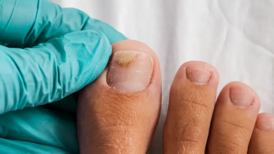 onycholysis on a toenail 1296x728 body1 (1)